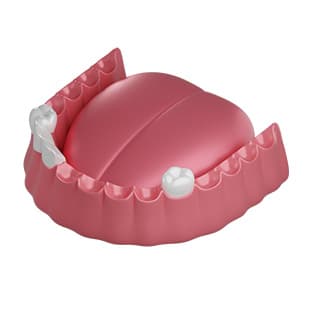 Нет большинства зубов